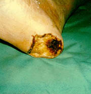Diabetes and Hyperbaric Oxygen Therapy
